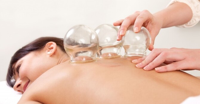 What Is Cupping?
