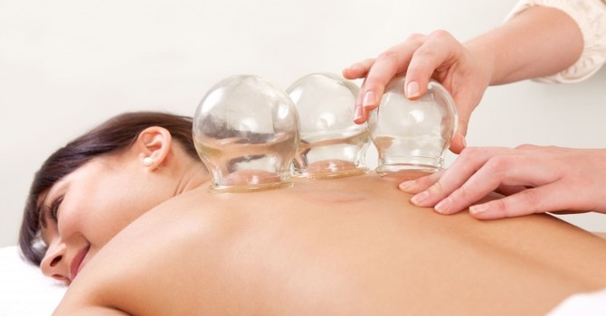 What Is Cupping? image
