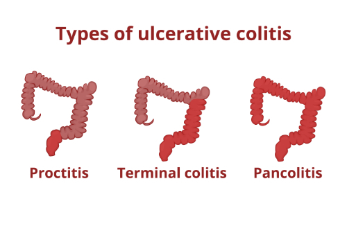 What Is Ulcerative Colitis? | NOVA Chiropractic & Acupuncture